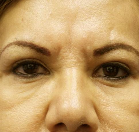 Blepharoplasty after at Aristocrat Plastic Surgery in Scarsdale, NY