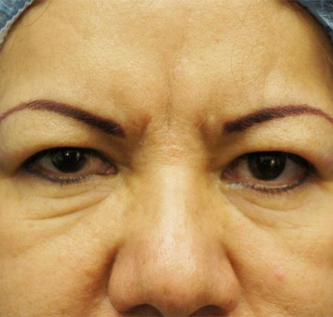 Blepharoplasty before at Aristocrat Plastic Surgery in Scarsdale, NY