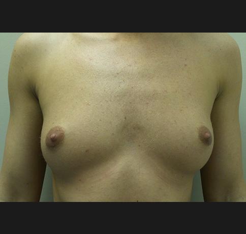 Breast Augmentation before at Aristocrat Plastic Surgery in Scarsdale, NY