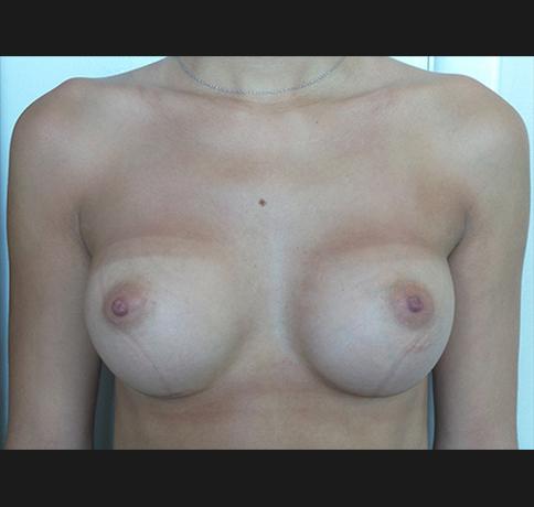 Breast Augmentation after at Aristocrat Plastic Surgery in Scarsdale, NY