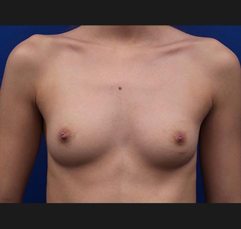 Breast Augmentation before at Aristocrat Plastic Surgery in Scarsdale, NY