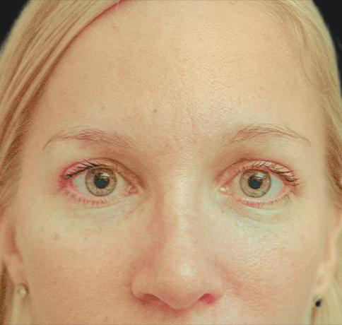 Aristocrat Plastic Surgery blepharoplasty after — Scarsdale, NY