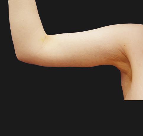 Aristocrat Plastic Surgery arm lift after — Scarsdale, NY