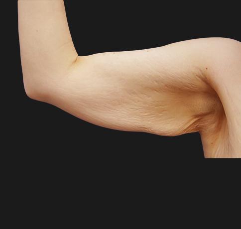 Arm Lift before at Aristocrat Plastic Surgery in Scarsdale, NY