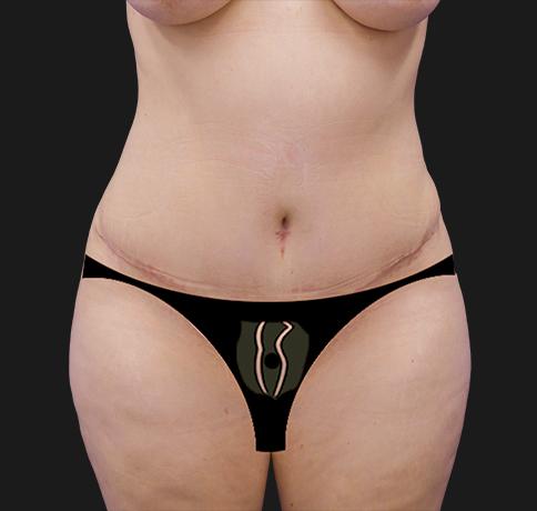Tummy Tuck after at Aristocrat Plastic Surgery in Scarsdale, NY