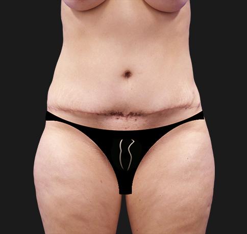 Tummy Tuck before at Aristocrat Plastic Surgery in Scarsdale, NY