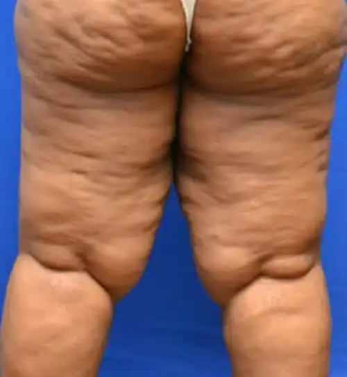 Thigh Lift before at Georgia Plastic & Reconstructive Surgery in Marietta, GA