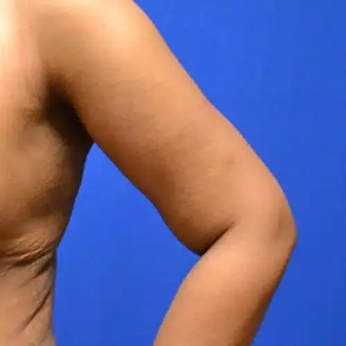 Arm Lift after at Georgia Plastic & Reconstructive Surgery in Marietta, GA
