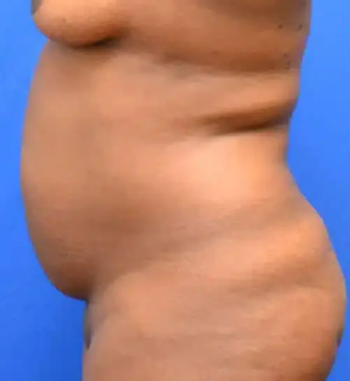Tummy Tuck before at Georgia Plastic & Reconstructive Surgery in Marietta, GA