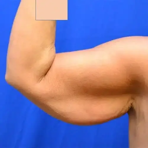 Arm Lift before at Georgia Plastic & Reconstructive Surgery in Marietta, GA