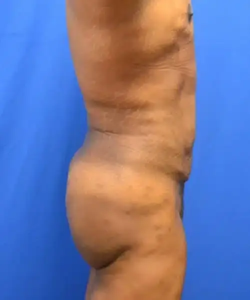 Brazilian Butt Lift after at Georgia Plastic & Reconstructive Surgery in Marietta, GA