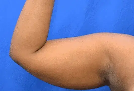 Arm Lift before at Georgia Plastic & Reconstructive Surgery in Marietta, GA