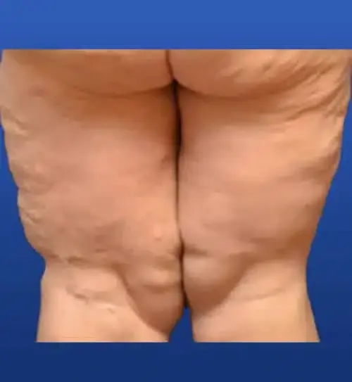 Thigh Lift before at Georgia Plastic & Reconstructive Surgery in Marietta, GA