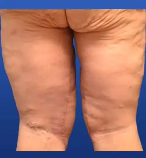 Georgia Plastic & Reconstructive Surgery thigh lift after — Marietta, GA