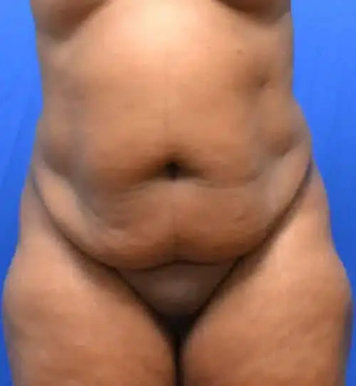 Tummy Tuck before at Georgia Plastic & Reconstructive Surgery in Marietta, GA