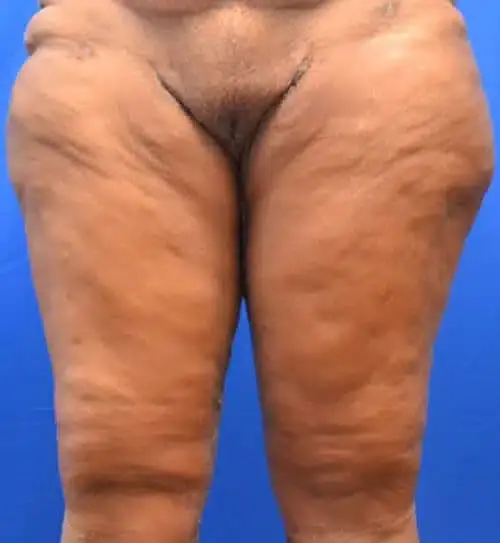 Thigh Lift after at Georgia Plastic & Reconstructive Surgery in Marietta, GA