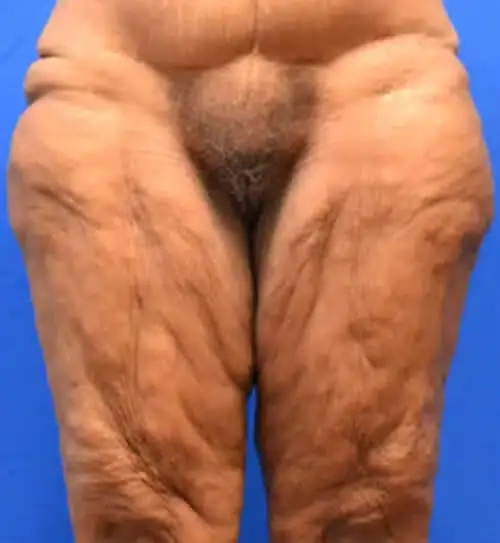 Thigh Lift before at Georgia Plastic & Reconstructive Surgery in Marietta, GA