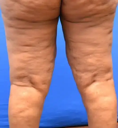 Georgia Plastic & Reconstructive Surgery thigh lift after — Marietta, GA
