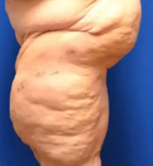 Thigh Lift before at Georgia Plastic & Reconstructive Surgery in Marietta, GA