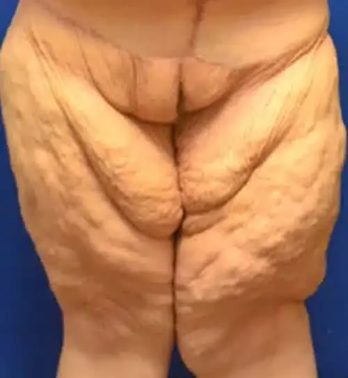 Thigh Lift before at Georgia Plastic & Reconstructive Surgery in Marietta, GA