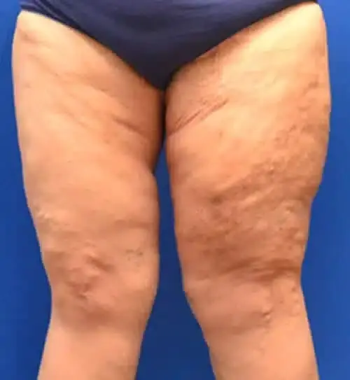 Georgia Plastic & Reconstructive Surgery thigh lift after — Marietta, GA