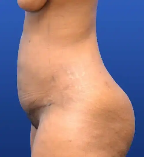 Tummy Tuck after at Georgia Plastic & Reconstructive Surgery in Marietta, GA