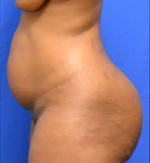Tummy Tuck before at Georgia Plastic & Reconstructive Surgery in Marietta, GA