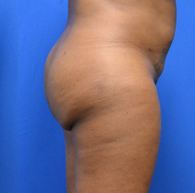 Brazilian Butt Lift after at Georgia Plastic & Reconstructive Surgery in Marietta, GA