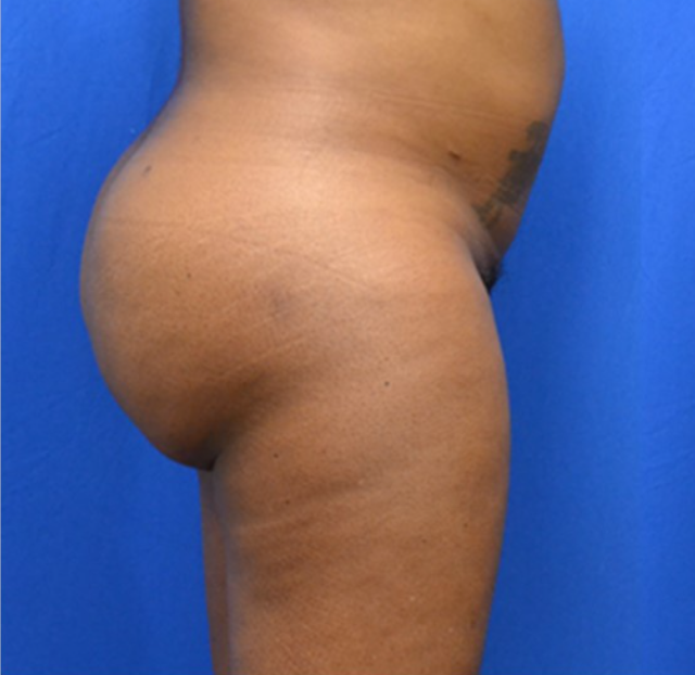 Brazilian Butt Lift before at Georgia Plastic & Reconstructive Surgery in Marietta, GA