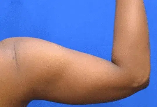 Arm Lift after at Georgia Plastic & Reconstructive Surgery in Marietta, GA