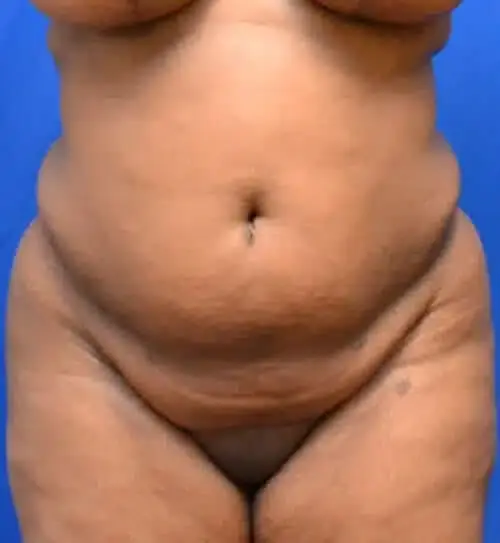 Tummy Tuck before at Georgia Plastic & Reconstructive Surgery in Marietta, GA