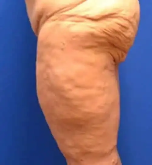 Georgia Plastic & Reconstructive Surgery thigh lift after — Marietta, GA