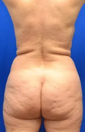 Brazilian Butt Lift before at Georgia Plastic & Reconstructive Surgery in Marietta, GA