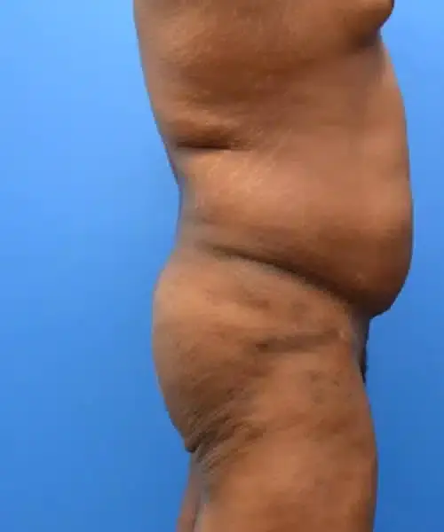 Brazilian Butt Lift before at Georgia Plastic & Reconstructive Surgery in Marietta, GA