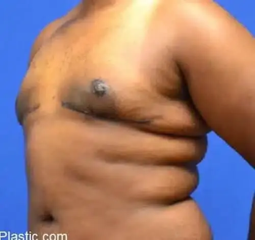 Georgia Plastic & Reconstructive Surgery gynecomastia after — Marietta, GA