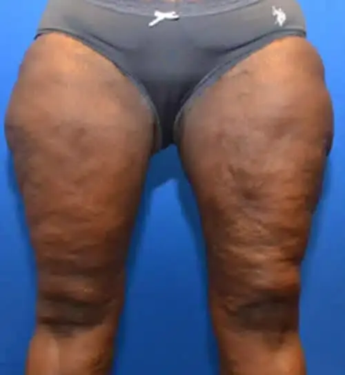 Georgia Plastic & Reconstructive Surgery thigh lift after — Marietta, GA