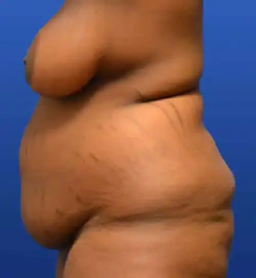 Tummy Tuck before at Georgia Plastic & Reconstructive Surgery in Marietta, GA