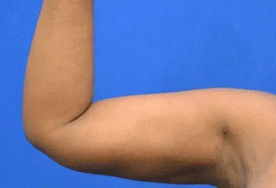 Arm Lift after at Georgia Plastic & Reconstructive Surgery in Marietta, GA