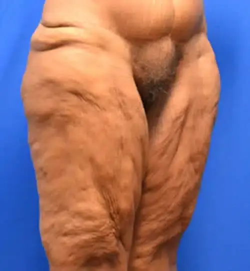 Thigh Lift before at Georgia Plastic & Reconstructive Surgery in Marietta, GA