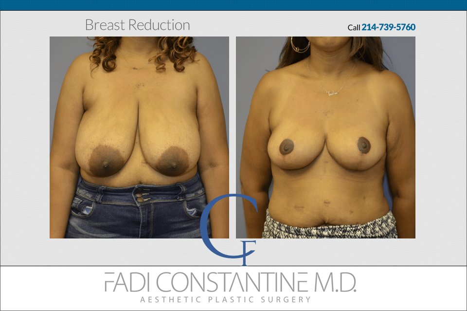 Constantine Plastic Surgery - Fadi Constantine MD result — Dallas, TX