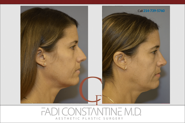 Liquid Rhinoplasty result at Constantine Plastic Surgery - Fadi Constantine MD in Dallas, TX