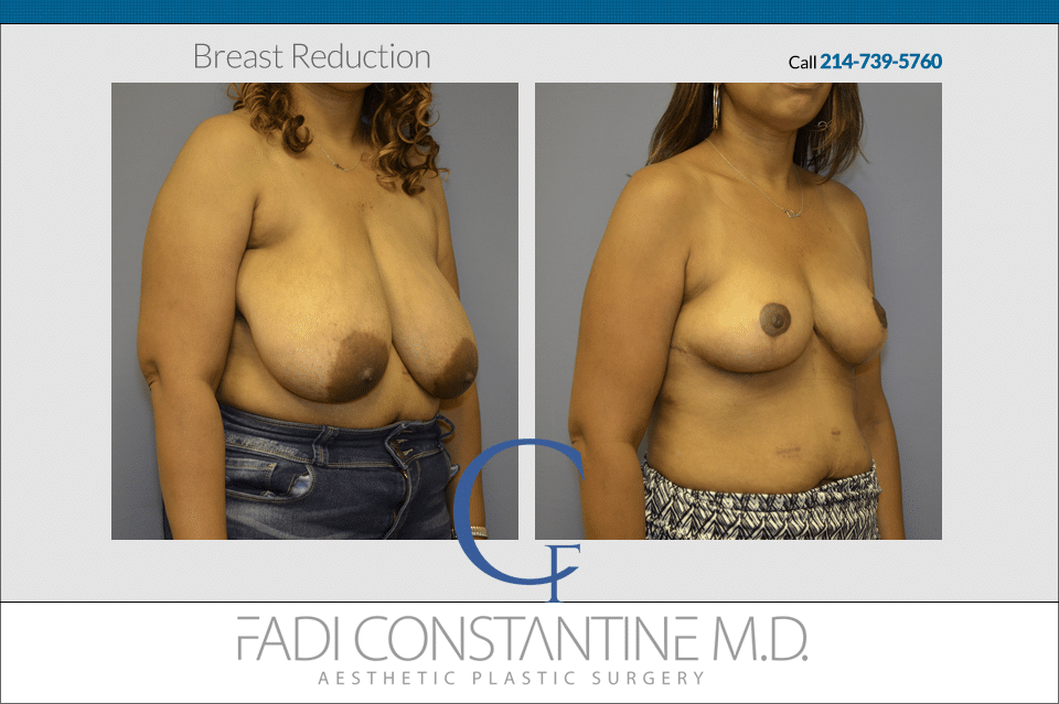 Constantine Plastic Surgery - Fadi Constantine MD result — Dallas, TX