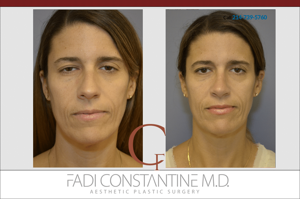 Constantine Plastic Surgery - Fadi Constantine MD result — Dallas, TX