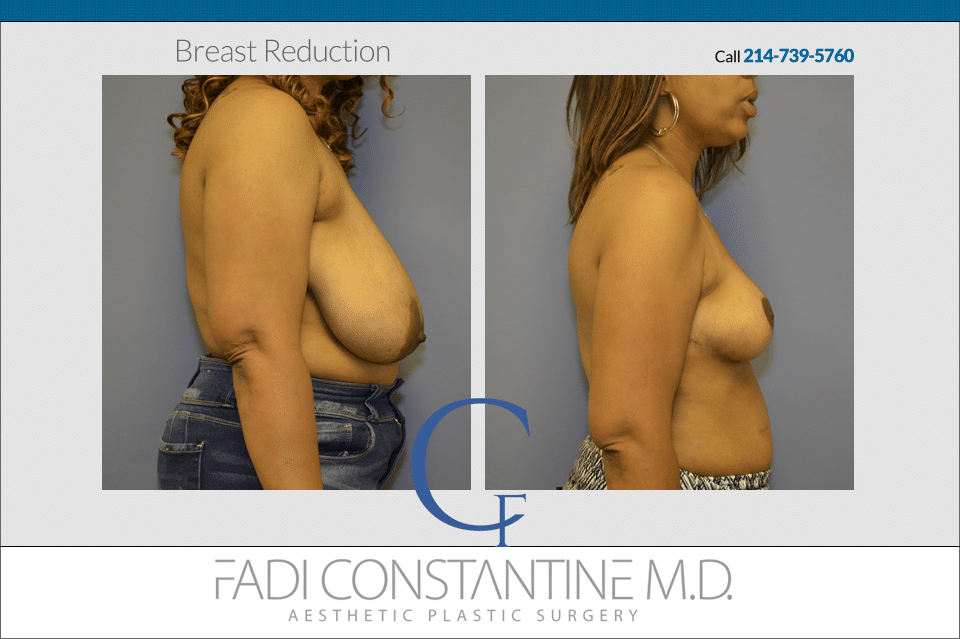 Constantine Plastic Surgery - Fadi Constantine MD result — Dallas, TX