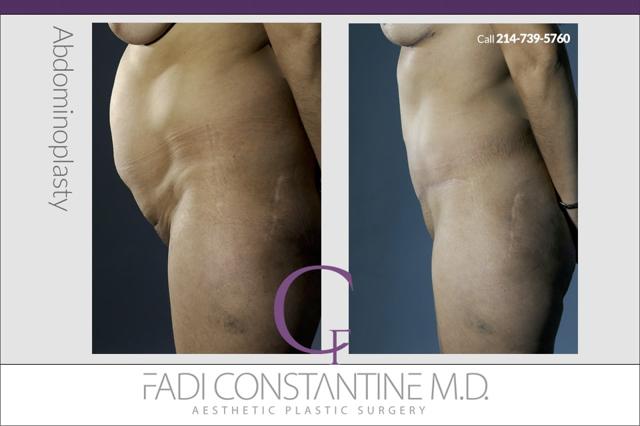 Tummy Tuck result at Constantine Plastic Surgery - Fadi Constantine MD in Dallas, TX