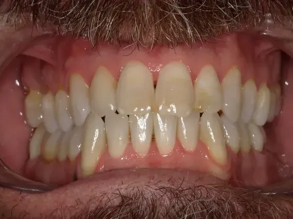 Teeth Whitening before at Westwood Family and Cosmetic Dentistry, Dr. David Reynolds DDS in Draper, UT