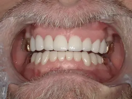 Westwood Family and Cosmetic Dentistry, Dr. David Reynolds DDS dental crowns after — Draper, UT