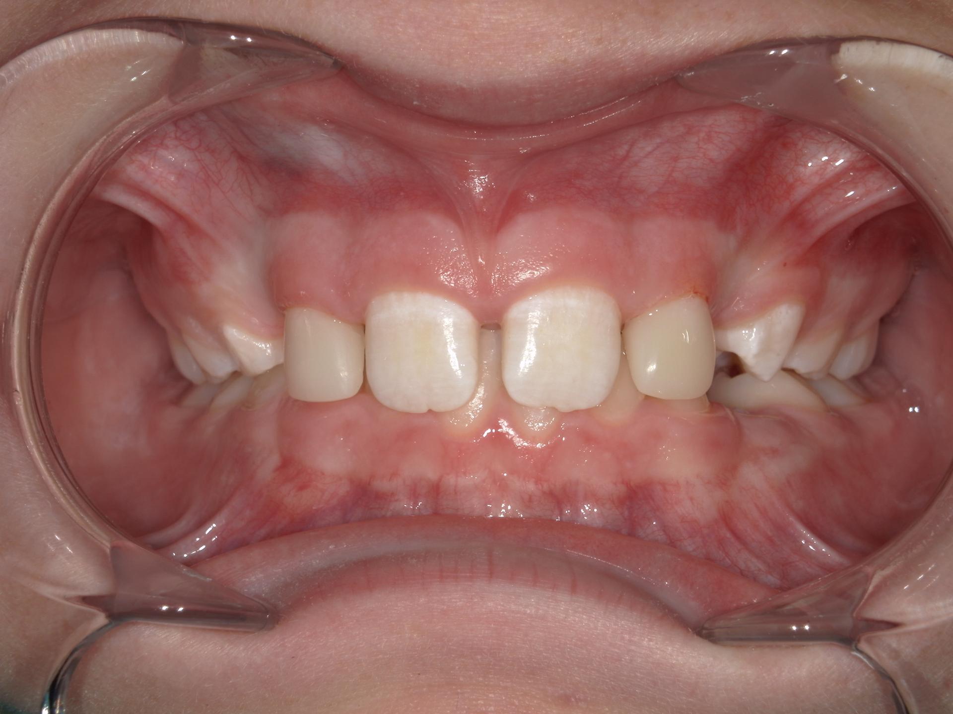 Westwood Family and Cosmetic Dentistry, Dr. David Reynolds DDS veneers after — Draper, UT