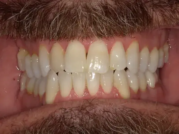 Teeth Whitening after at Westwood Family and Cosmetic Dentistry, Dr. David Reynolds DDS in Draper, UT