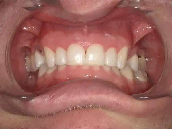 Westwood Family and Cosmetic Dentistry, Dr. David Reynolds DDS veneers after — Draper, UT